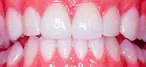 Lumineers Veneers